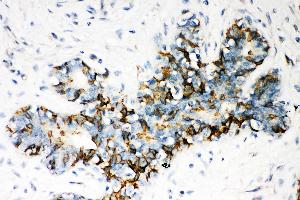 Anti- ABCB4 Picoband antibody, IHC(P) IHC(P): Human Mammary Cancer Tissue (ABCB4 抗体  (AA 601-720))