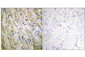 Immunohistochemical analysis of paraffin-embedded human prostate carcinoma tissue using Prostate-specific Antigen antibody (ABIN5976496). (Prostate Specific Antigen 抗体  (Internal Region))