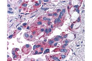 Anti-MRGPRX2 / MRGX2 antibody IHC of human Lung, Non-Small Cell Carcinoma. (MRGPRX2 抗体  (Extracellular Domain))
