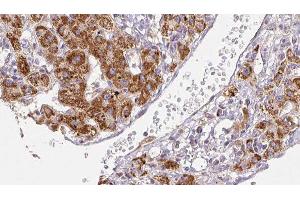 ABIN6278491 at 1/100 staining Human liver cancer tissue by IHC-P. (SCN2A 抗体  (Internal Region))