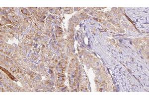 ABIN6267113 at 1/100 staining Human thyroid cancer tissue by IHC-P.