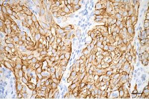 Immunohistochemistry was performed on paraffin-embedded human breast carcinoma using CDH1 antibody (ABIN7797819), 1:200).