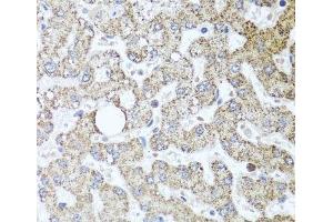 Immunohistochemistry of paraffin-embedded Human liver damage using TSG101 Polyclonal Antibody at dilution of 1:100 (40x lens). (TSG101 抗体)