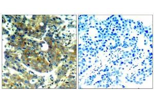 Immunohistochemical analysis of paraffin-embedded human breast carcinoma tissue, using p70 S6 Kinase (phospho-Ser411) antibody (E011269). (RPS6KB1 抗体  (pSer411))