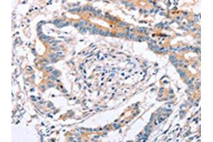 The image on the left is immunohistochemistry of paraffin-embedded Human colon cancer tissue using ABIN7129824(IGSF8 Antibody) at dilution 1/15, on the right is treated with fusion protein. (IGSF8 抗体)