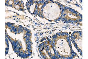 ABIN6261350 and ABIN6266893 at 1/100 staining Human colorectal cancer by IHC-P. (DOK3 抗体  (Internal Region))