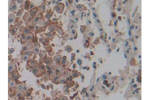 DAB staining on IHC-P; Samples: Human Lung cancer Tissue) (IL1A 抗体  (AA 113-271))