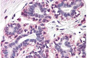 Human Breast (formalin-fixed, paraffin-embedded) stained with RAMP3 antibody ABIN290466 at 20 ug/ml followed by biotinylated goat anti-rabbit IgG secondary antibody ABIN481713, alkaline phosphatase-streptavidin and chromogen. (RAMP3 抗体  (N-Term))