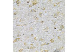 Immunohistochemistry of paraffin-embedded human brain cancer using CAMK1D Antibody (ABIN5975586) at dilution of 1/100 (40x lens). (CAMK1D 抗体)