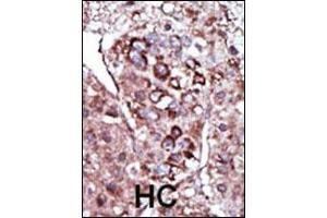 Formalin-fixed and paraffin-embedded human cancer tissue reacted with the primary antibody, which was peroxidase-conjugated to the secondary antibody, followed by AEC staining. (DGKZ 抗体  (C-Term))