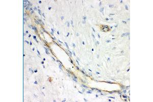Anti- GCLC antibody, IHC(P) IHC(P): Human Mammary Cancer Tissue (GCLC 抗体  (AA 437-637))