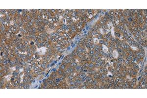 Immunohistochemistry of paraffin-embedded Human ovarian cancer using GABRB1 Polyclonal Antibody at dilution of 1:50 (GABRB1 抗体)