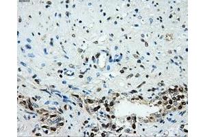 Immunohistochemical staining of paraffin-embedded prostate tissue using anti-HK2mouse monoclonal antibody. (Hexokinase 2 抗体)