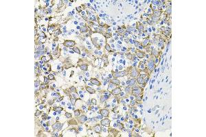 Immunohistochemistry of paraffin-embedded human esophageal cancer using ACVR2A antibody. (ACVR2A 抗体)