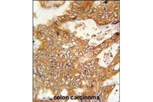 FBXO34 Antibody (C-term) (ABIN651879 and ABIN2840436) immunohistochemistry analysis in formalin fixed and paraffin embedded human colon carcinoma followed by peroxidase conjugation of the secondary antibody and DAB staining.