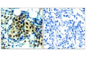 Immunohistochemical analysis of paraffin-embedded human breast carcinoma tissue using p44/42 MAP Kinase (phospho-Thr202) antibody (E011245). (ERK1/2 抗体  (pThr202))