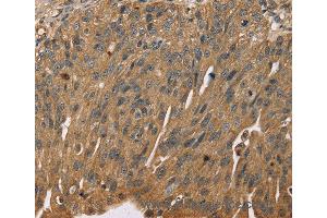 Immunohistochemistry of Human breast cancer using SCGB2A1 Polyclonal Antibody at dilution of 1:50 (SCGB2A1 抗体)