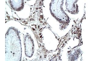 Formalin-fixed and paraffin embedded human colon labeled with Rabbit Anti eIF3F Polyclonal Antibody, Unconjugated (ABIN704906) at 1:200 followed by conjugation to the secondary antibody and DAB staining (e3F (AA 112-210) 抗体)