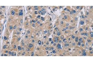 Immunohistochemistry of paraffin-embedded Human liver cancer tissue using NME5 Polyclonal Antibody at dilution 1:50 (NME5 抗体)
