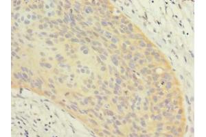 Immunohistochemistry of paraffin-embedded human cervical cancer using ABIN7162366 at dilution of 1:100 (OXR1 抗体  (AA 401-600))