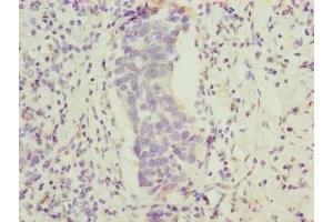 Immunohistochemistry of paraffin-embedded human bladder cancer using ABIN7165470 at dilution of 1:100 (FAM222B 抗体  (AA 351-562))