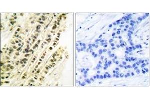 Immunohistochemistry analysis of paraffin-embedded human breast carcinoma tissue, using SRF (Ab-99) Antibody. (SRF 抗体  (AA 71-120))