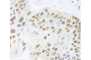 Immunohistochemistry of paraffin-embedded Human lung cancer using ZBTB17 Polyclonal Antibody at dilution of 1:100 (40x lens). (ZBTB17 抗体)