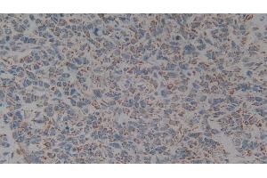 Detection of C1QBP in Human Lung cancer Tissue using Polyclonal Antibody to Complement component 1 Q subcomponent-binding protein, mitochondrial (C1QBP)