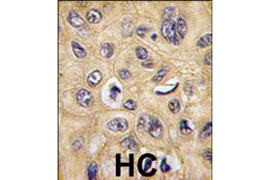 Formalin-fixed and paraffin-embedded human hepatocellular carcinoma reacted with TSC2 polyclonal antibody  , which was peroxidase-conjugated to the secondary antibody, followed by DAB staining .