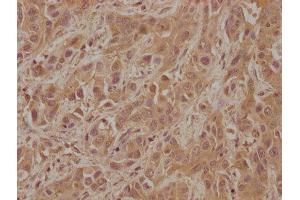 IHC image of ABIN7152833 diluted at 1:100 and staining in paraffin-embedded human liver cancer performed on a Leica BondTM system. (FGFR2 抗体  (AA 577-821))