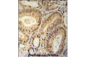 RBM24 Antibody (N-term) (ABIN651797 and ABIN2840402) immunohistochemistry analysis in formalin fixed and paraffin embedded human prostate carcinoma followed by peroxidase conjugation of the secondary antibody and DAB staining. (RBM24 抗体  (N-Term))