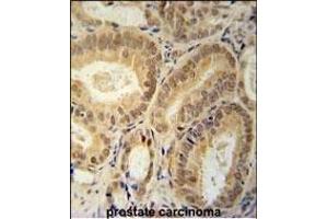 RBM24 Antibody (N-term) (ABIN651797 and ABIN2840402) immunohistochemistry analysis in formalin fixed and paraffin embedded human prostate carcinoma followed by peroxidase conjugation of the secondary antibody and DAB staining.
