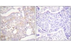 Immunohistochemistry analysis of paraffin-embedded human breast carcinoma tissue, using Claudin 4 Antibody.