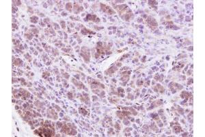 IHC-P Image MAP4K1 antibody [N1], N-term detects MAP4K1 protein at cytosol on BT438 xenograft by immunohistochemical analysis. (MAP4K1 抗体  (N-Term))