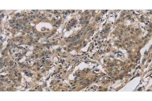 Immunohistochemistry of paraffin-embedded Human gastic cancer using DHRS3 Polyclonal Antibody at dilution of 1:30 (DHRS3 抗体)