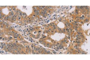 Immunohistochemistry of paraffin-embedded Human gastric cancer using CDK11B Polyclonal Antibody at dilution of 1:40 (CDK11 抗体)