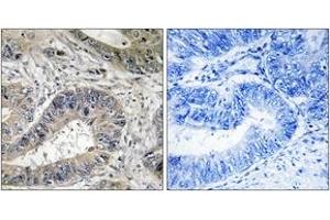 Immunohistochemistry analysis of paraffin-embedded human colon carcinoma tissue, using ERN2 Antibody. (ERN2 抗体  (AA 841-890))