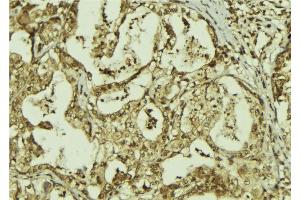 ABIN6273306 at 1/100 staining Human breast cancer tissue by IHC-P. (RBBP9 抗体  (Internal Region))