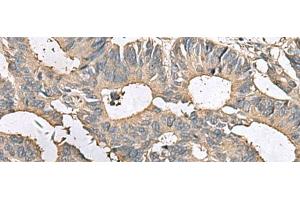 Immunohistochemistry of paraffin-embedded Human colorectal cancer tissue using MRPL42 Polyclonal Antibody at dilution of 1:65(x200) (MRPL42 抗体)