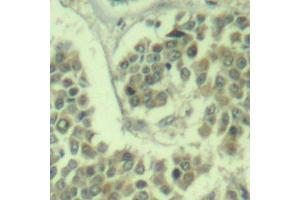 Immunohistochemistry of paraffin-embedded human breast carcinoma using Phospho-eIF2α-S49 antibody (ABIN2987986). (EIF2S1 抗体  (pSer49))