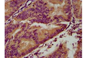 IHC image of ABIN7166221 diluted at 1:200 and staining in paraffin-embedded human endometrial cancer performed on a Leica BondTM system. (IGSF9 抗体  (AA 132-298))