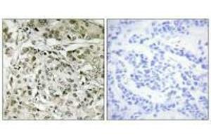 Immunohistochemistry analysis of paraffin-embedded human breast carcinoma tissue, using TAF1 antibody.