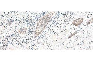 Immunohistochemistry of paraffin-embedded Human esophagus cancer tissue using ARL2BP Polyclonal Antibody at dilution of 1:50(x200) (ARL2BP 抗体)