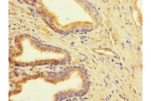Immunohistochemistry of paraffin-embedded human prostate cancer using ABIN7147948 at dilution of 1:100 (CLUAP1 抗体  (AA 161-413))