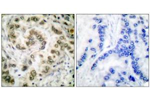 Immunohistochemical analysis of paraffin-embedded human lung carcinoma tissue, using E2F4 antibody (ABIN5976385).