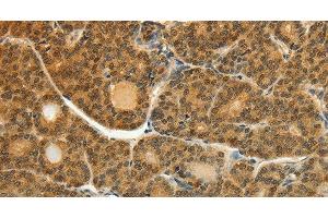 Immunohistochemistry of paraffin-embedded Human thyroid cancer tissue using SOCS5 Polyclonal Antibody at dilution 1:35 (SOCS5 抗体)