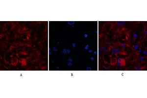Immunofluorescence analysis of human breast cancer tissue. (Caspase 8 抗体  (Cleaved-Asp384))