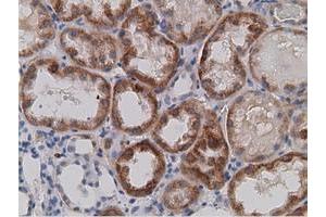 Immunohistochemical staining of paraffin-embedded Carcinoma of Human kidney tissue using anti-SDR9C7 mouse monoclonal antibody. (SDR9C7 抗体)