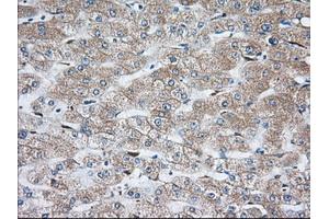 Immunohistochemical staining of paraffin-embedded Carcinoma of Human thyroid tissue using anti-TBXAS1 mouse monoclonal antibody. (TBXAS1 抗体)