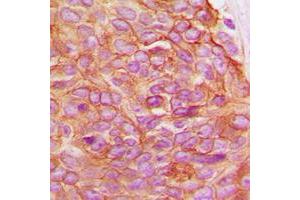 Immunohistochemical analysis of Gamma-catenin staining in human breast cancer formalin fixed paraffin embedded tissue section. (JUP 抗体  (C-Term))